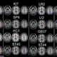 Image for article titled Proof That Acupuncture Really Does Activate Specific Parts of the Brain